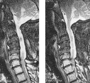 myelomalacia cervical