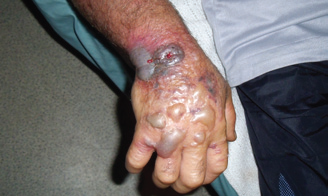Cutaneous anthrax on hand Skin ulcer caused by cutaneous anthrax