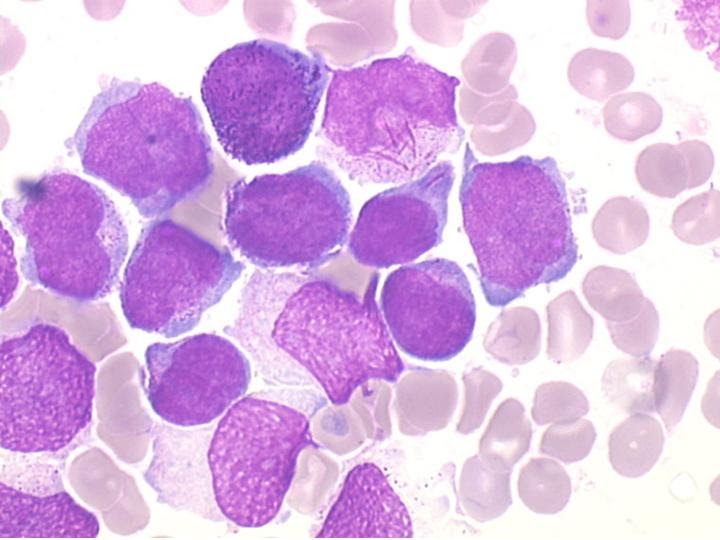 Leucémie Aiguë Lymphoblastique