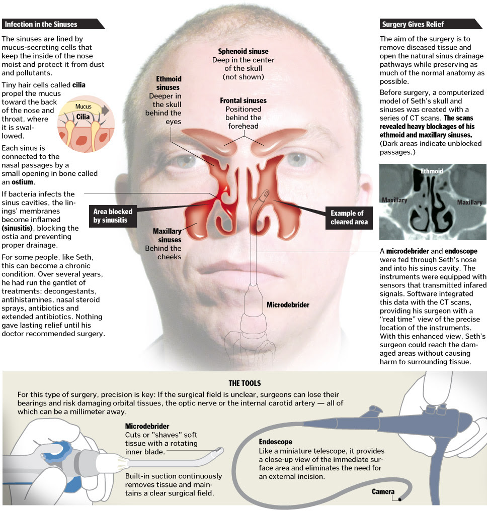 A Better Tomorrow Image Guided Sinus Surgery