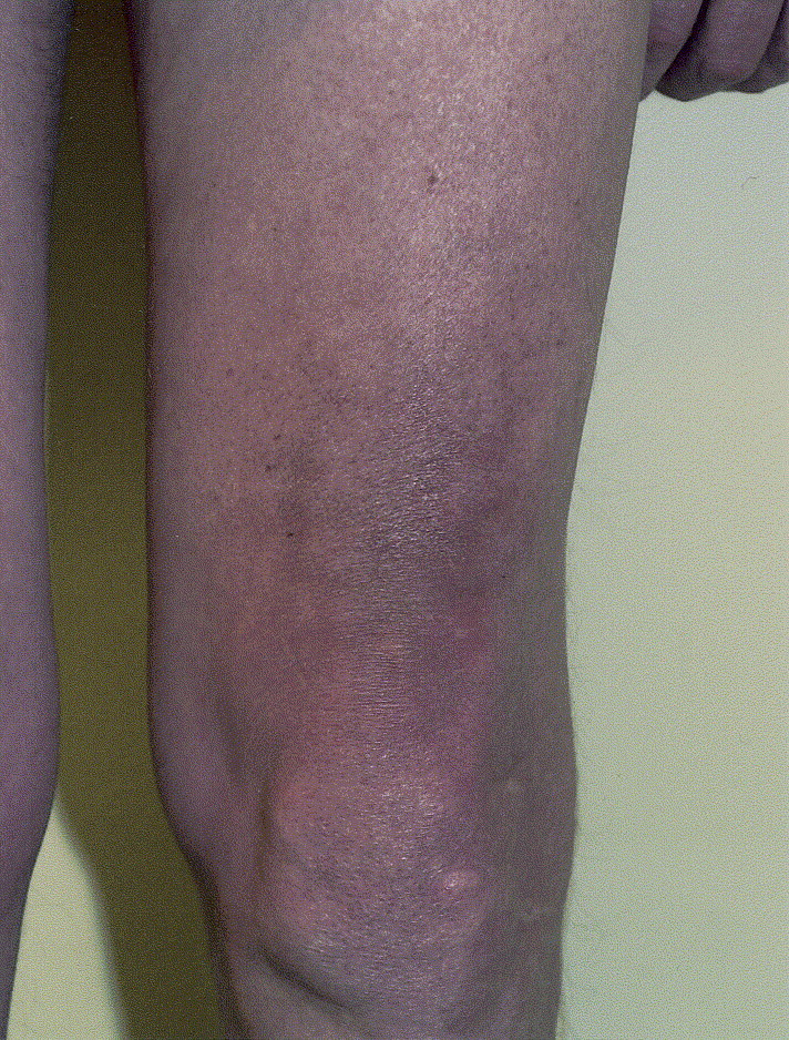 Toasted Skin Syndrome Erythema Ab Igne | Decorative Journals