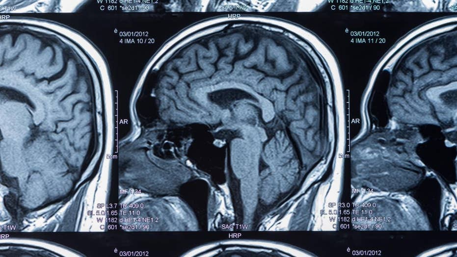 Cte Brain : REPORT: Photos Reveal Aaron Hernandez Had Worst CTE Of