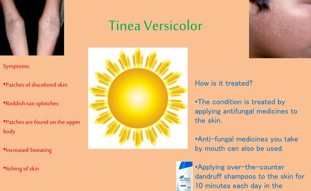 what over the counter medicine is good for tinea versicolor