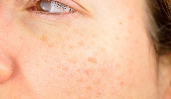 Lighten Your Age Spots With Natural Home Remedies