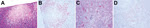 Thumbnail of Histopathologic and immunohistochemical (IHC) testing results for Baikal teal. A) Focal necrosis in pancreas (hematoxylin and eosin [H&amp;E] stain). B) Avian influenza virus antigen in necrotic pancreatic acini ([IHC stain). C) Gout and renal tubular necrosis (H&amp;E stain). D) Avian influenza virus antigen in renal tubule cells (IHC stain). Original magnifications ×100.