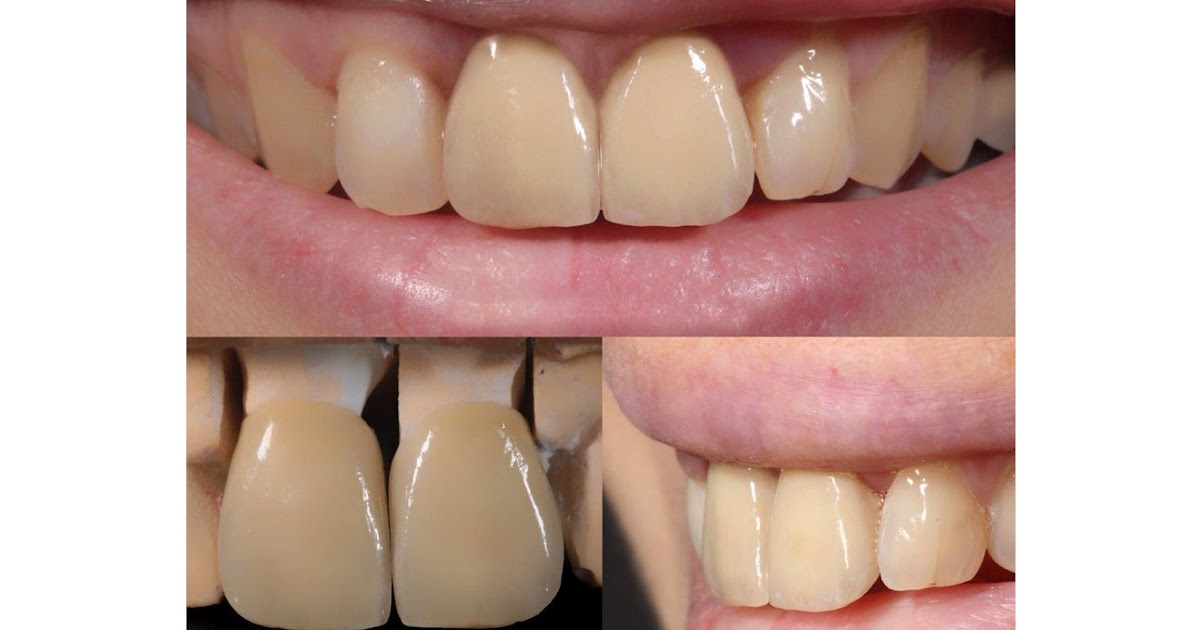 Dental Crown Cost With Insurance / Dental Crowns