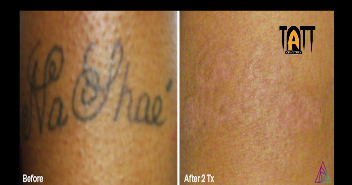 Hydrogen Peroxide Tattoo Removal Before And After
