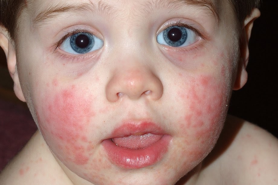 Viral Rash Toddler Face Gue Viral