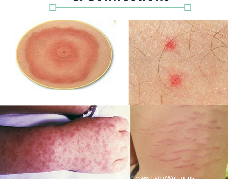 Itchy Kidney Disease Skin Rash Pictures Kidkads
