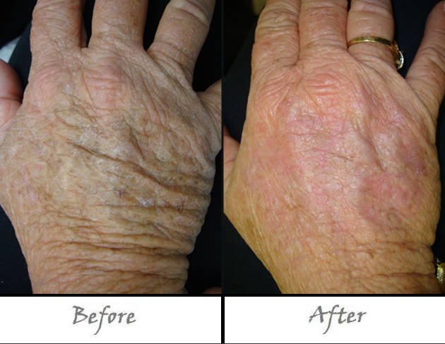 hand fraxel scars rejuvenation wrinkles remove burns treatment lasers amazing using painlessly quickly