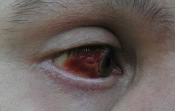 My eye My eye