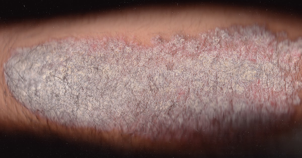 The Painful Truth About Psoriasis In A Nutshell