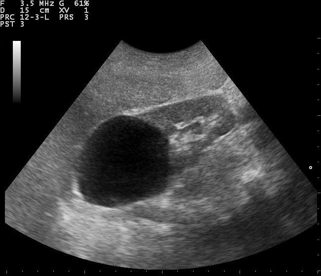 Kidney Cyst Ultrasound Pictures - kidausx