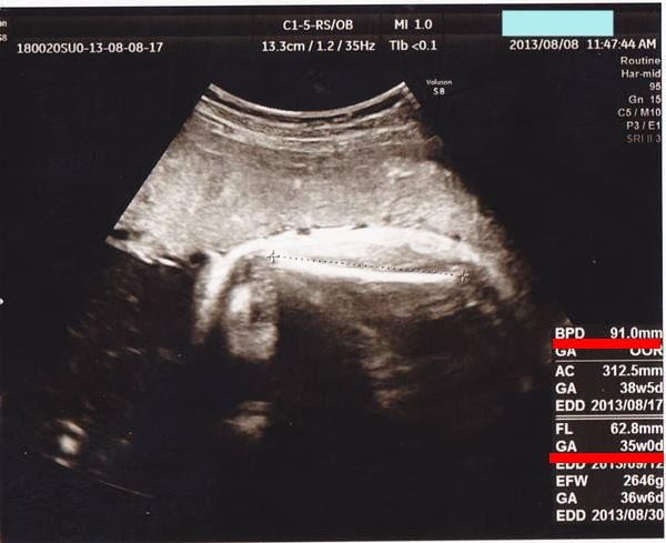 【35++】 38週 胎児 頭の大きさ 無料 1000+ 画像コレクション