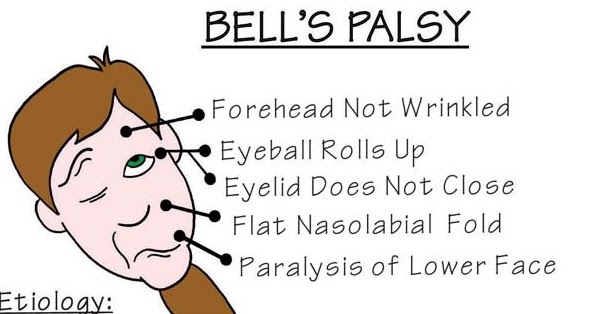 Nursing Mnemonics Bells Palsy StudyPK Nursing Mnemonics Bells Palsy StudyPK