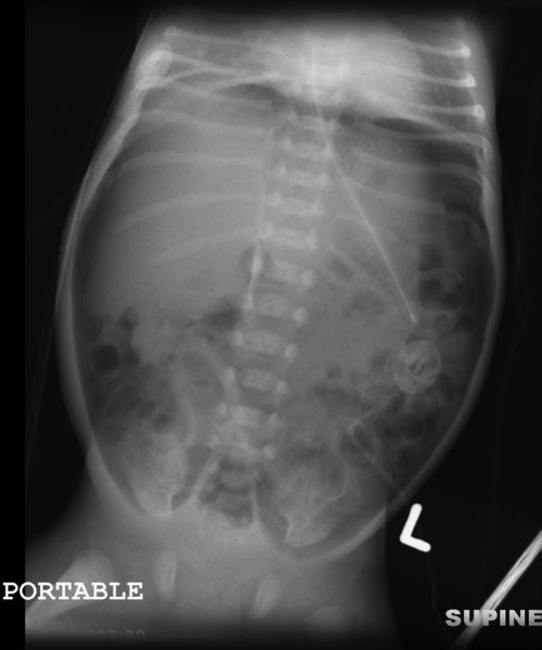 radiology-signs-quiz-unwell-neonate-what-is-this-sign-called-and