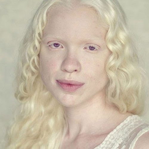 A beleza única dos albinos A beleza única dos albinos