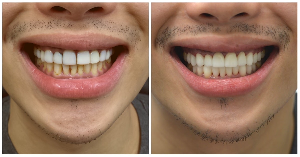 How Much Does It Cost To Shave Teeth TeethWalls