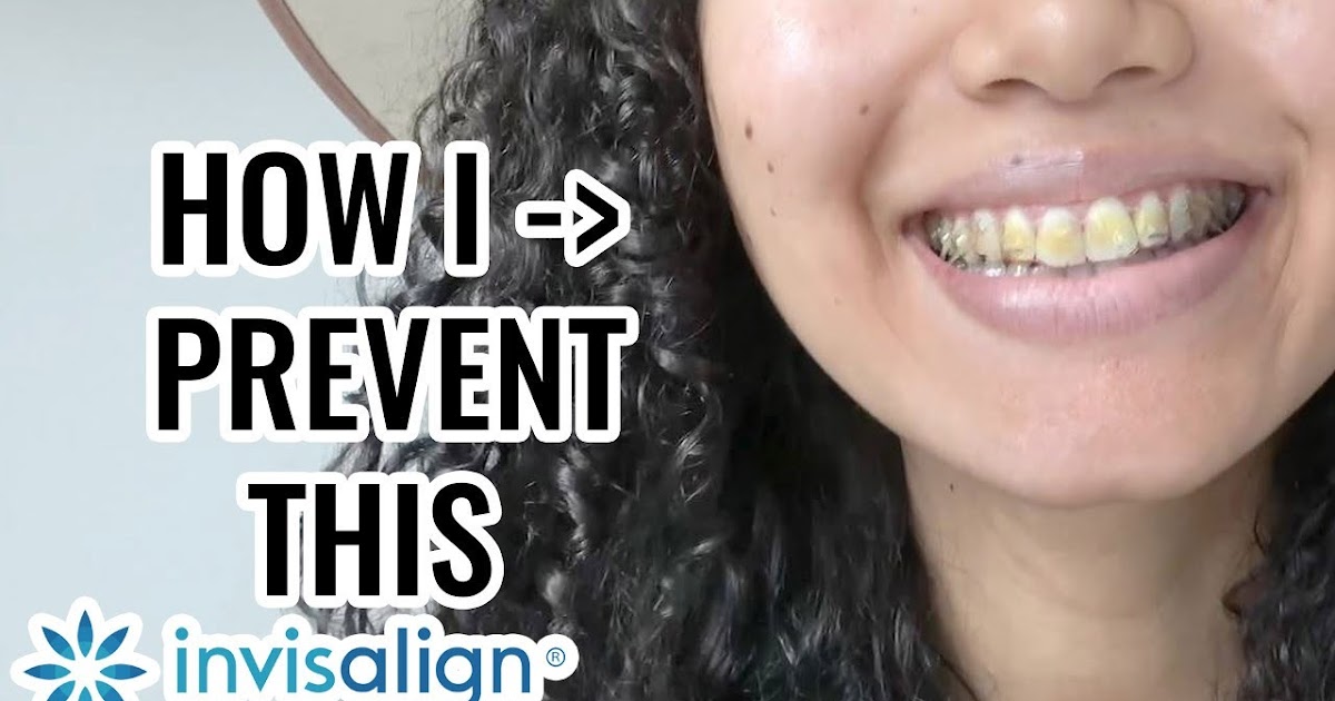Does Coffee Stain Invisalign : Alcohol Coffee Soda What S Safe To Drink