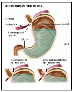 Acid Reflux (GERD): Lower esophageal sphincter