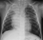 Thumbnail of Chest radiograph of the index patient, a 16-month-old boy in Finland with human bocavirus 1 pneumonia, on day 2 of hospitalization. Bilateral pulmonary infiltrations and atelectasis of the upper right lobe can be seen.