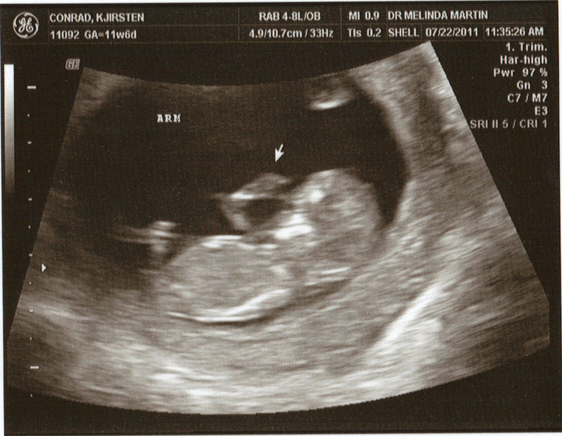 dating scan at 9 weeks