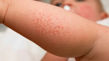 Baby Viral Rash How Long Does It Last - Baby Viewer
