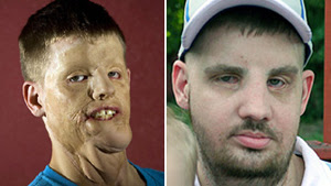 Mitch Hunter, antes e depois da cirurgia que reconstruiu sua face, destruída após uma descarga elétrica. (Foto: BBC) Mitch Hunter, antes e depois da cirurgia que reconstruiu sua face, destruída após uma descarga elétrica. (Foto: BBC)