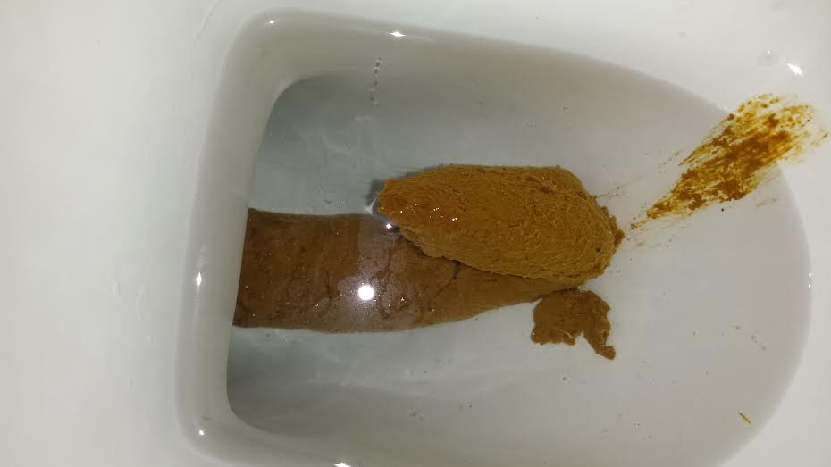 Oily Stool Pictures - Stools