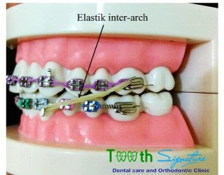 Gambar Kawat Warna Pasang Behel Jakarta Pastikan Model Gambar Kawat Warna Pasang Behel Jakarta Pastikan Model