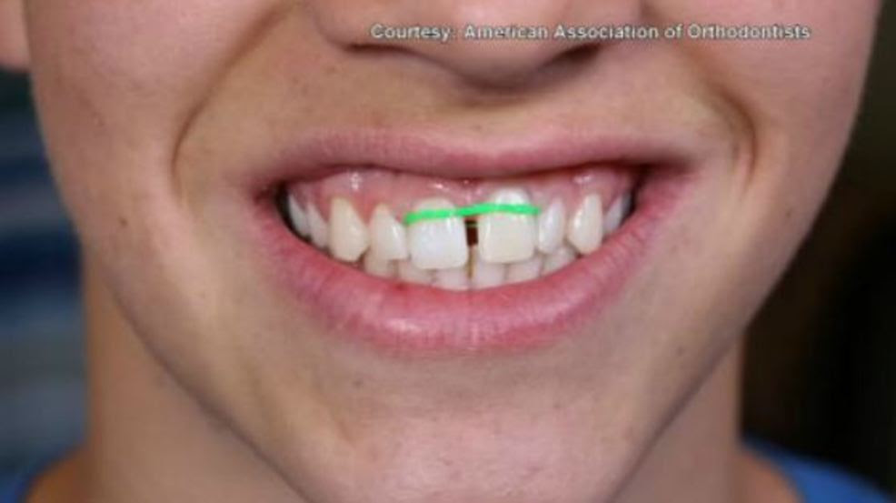 How To Use Rubber Bands To Close Gaps In Teeth TeethWalls