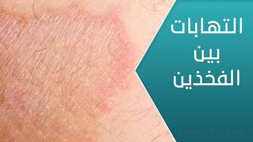 علاج التهابات الجلد بين الفخذين وأسفل الخصيتين بالزيوت والاعشاب الطبيعية