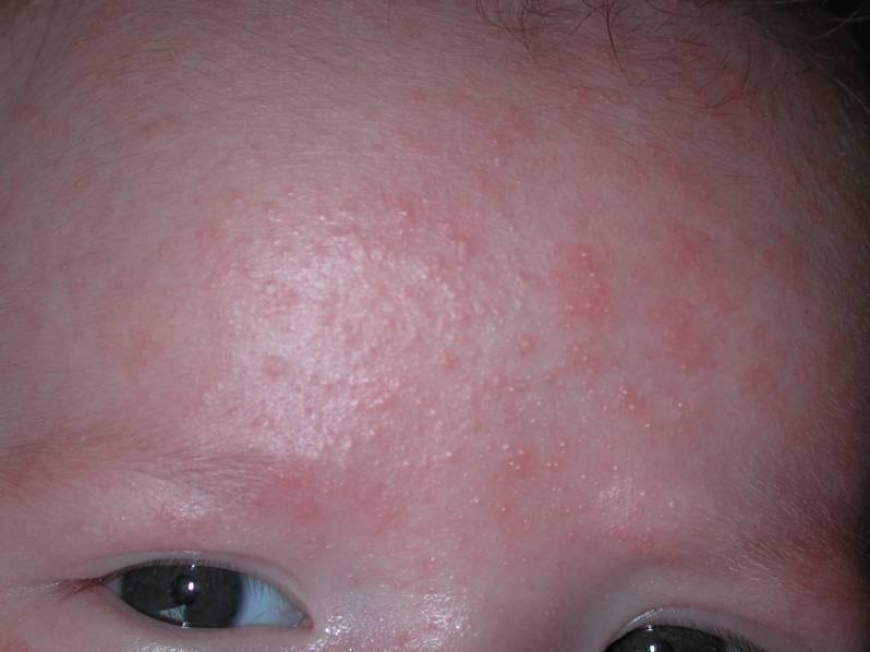 Skin Rashes in Children on Face in Adults on Hands on Arms that Itch In ...