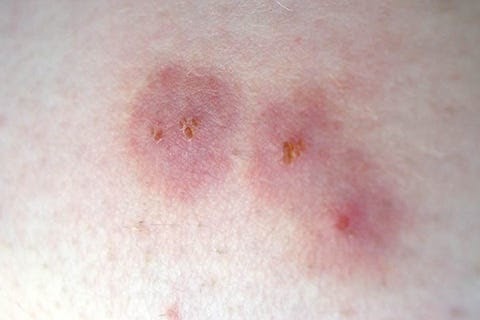 Black Widow Bites Pictures / Black Widow Bites What Happens Can It Kill