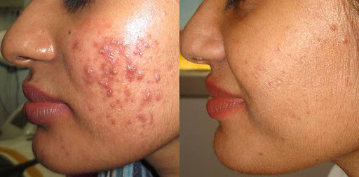 Skin Treatment 3