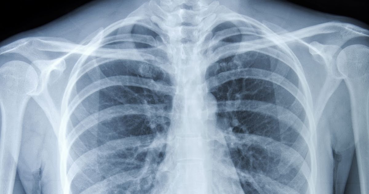 Chest X Ray Cost Without Insurance / California Mobile X
