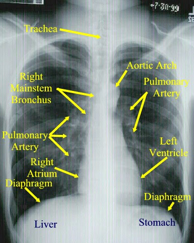 Medicine and Exam :-): What is the main constituent of the hilar ...