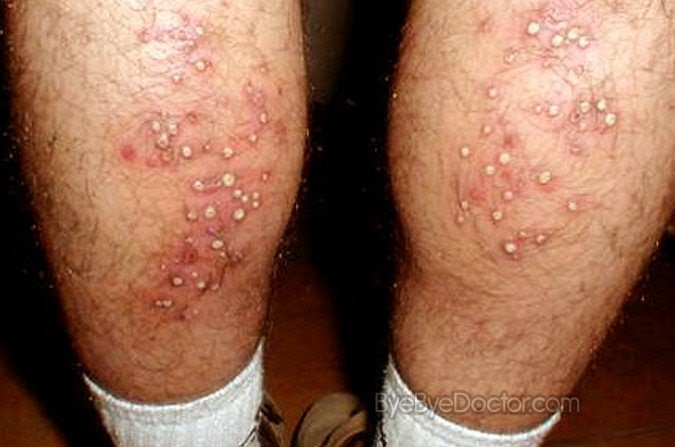 Hot Tub Rash Minhhai2d Help Doctor