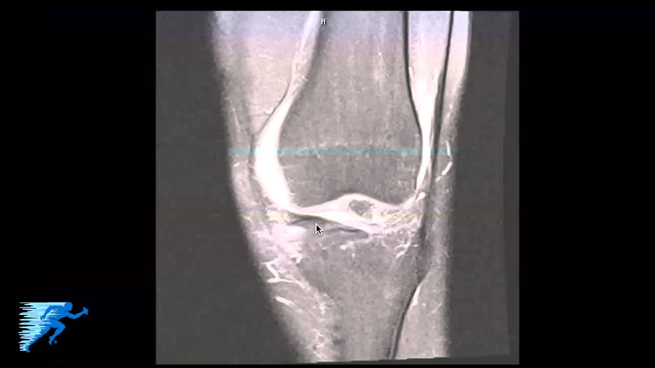 56 Popular Exterior cruciate ligament injury with Photos Design