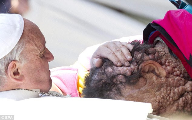 Disfigured Guy - Touching moment Pope Francis kiss and hold a disfigured man ...