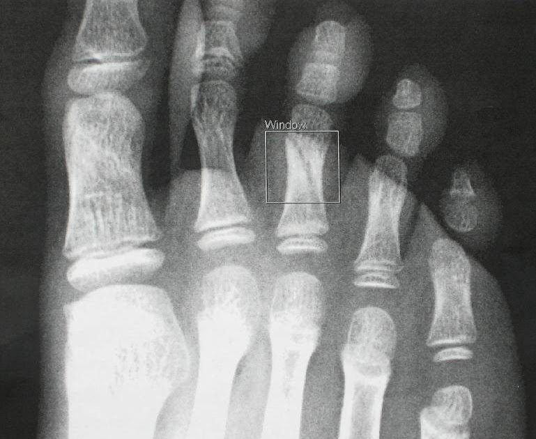 fractured-little-toe-fracture-treatment