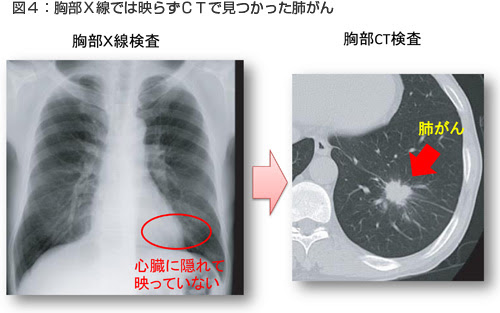 レントゲン 影 肺 白い