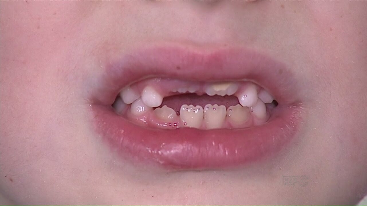 Quantos Dentes Uma Criança De 10 Anos Tem - Relacionado a Crianças