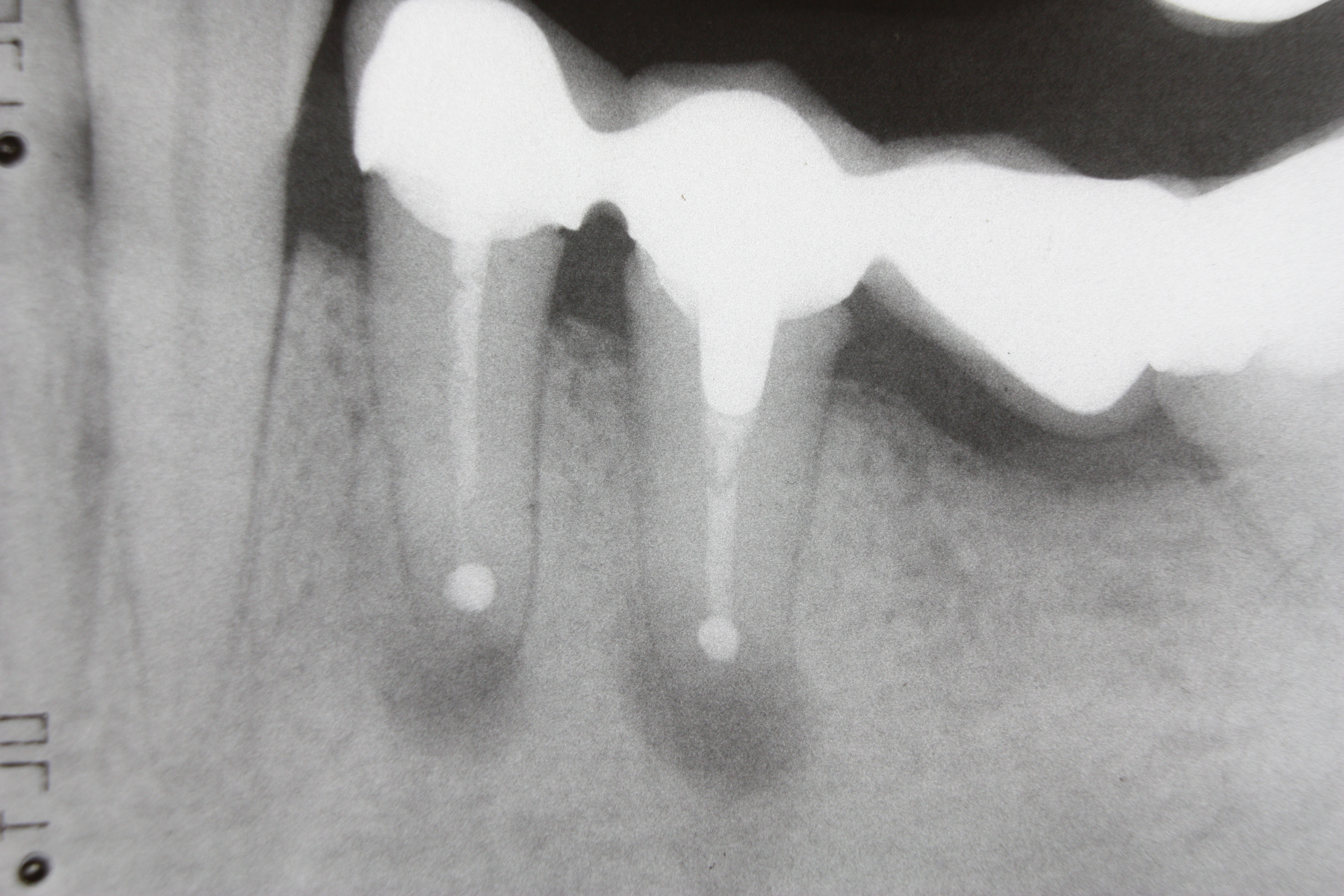 The Stochastic Scientist Dental xrays and cancer