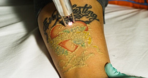 Tattoo removal pensacola fl cost How to remove your