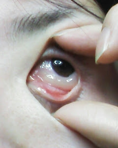 猫 アレルギー 目 が 腫れる
