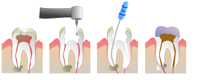 Image:Root Canal Illustration Molar.svg