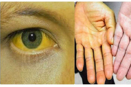 Cách trị bệnh vàng da ở người lớn và những điều cần biết