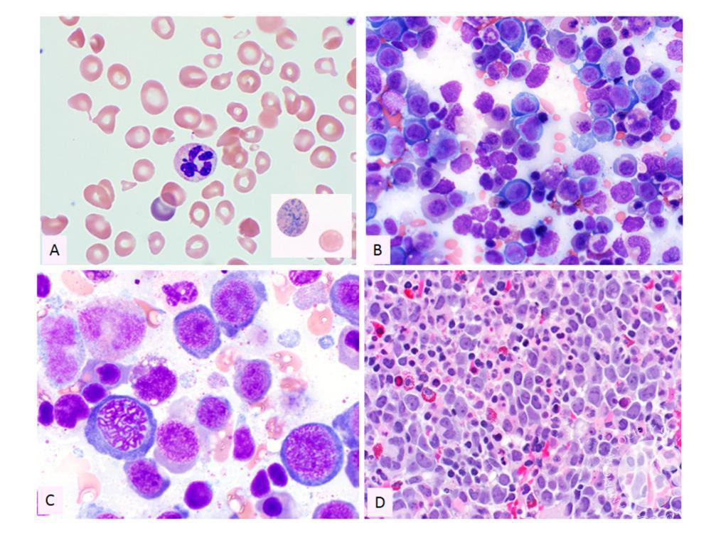 Megaloblastic anemia caused by severe B12 deficiency in a Megaloblastic anemia caused by severe B12 deficiency in a