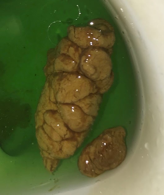 Amazing Brown Mucus With Stool of all time Learn more here 